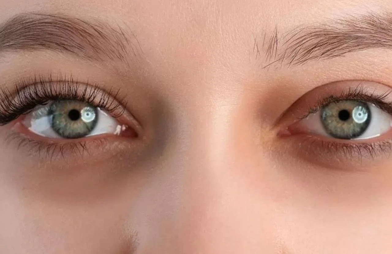 Göz altı morlukları için etkili doğal tedavi yöntemleri: Evde göz altı morlukları nasıl geçer? - 1. Resim