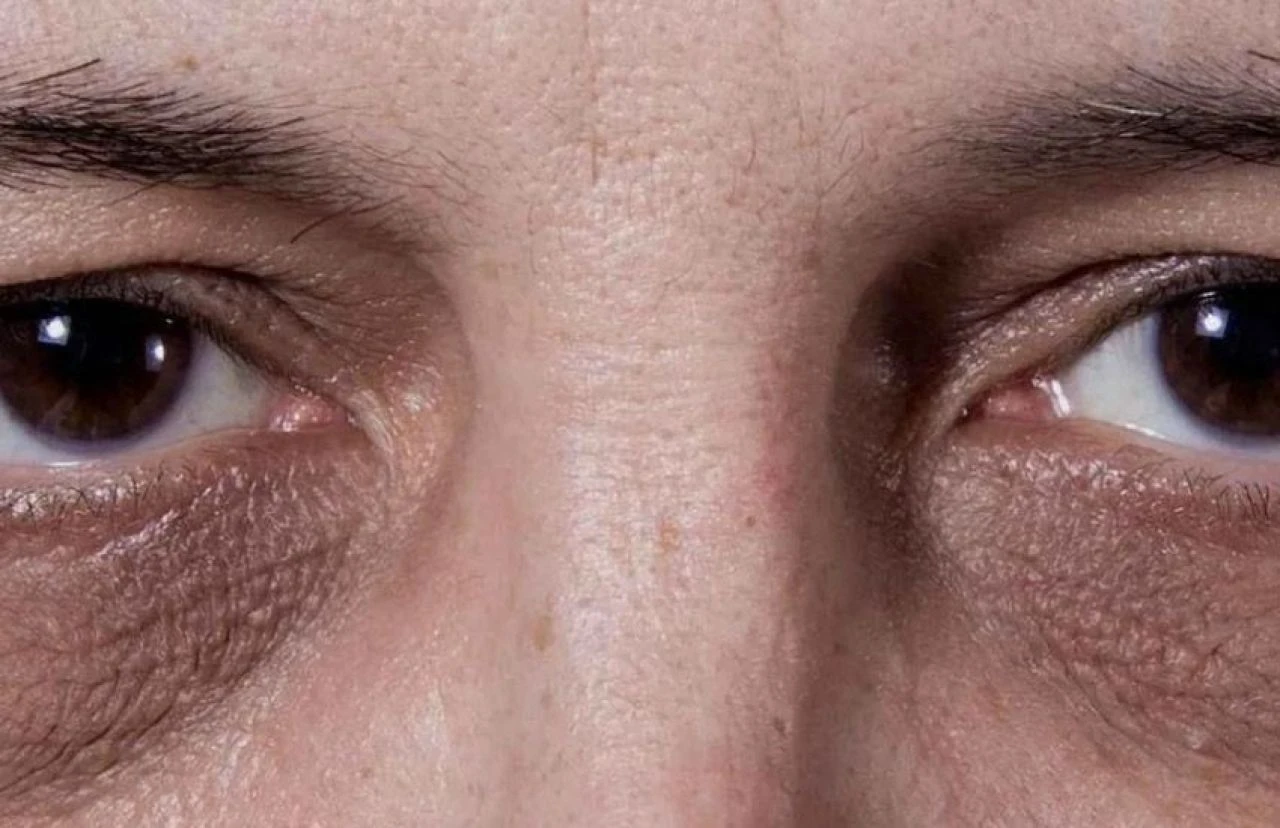 Göz altı morlukları için etkili doğal tedavi yöntemleri: Evde göz altı morlukları nasıl geçer? - 3. Resim