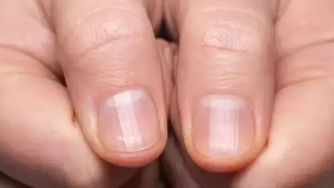 Tırnaktaki dikey çizgiler, vitamin eksikliği sanılırken gerçek bambaşka çıktı! Şekline dikkat edin - 4. Resim