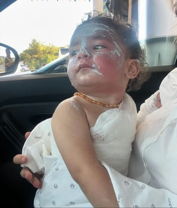 Kreşte 1,5 yaşındaki bebeğin yüzü ve kolları yandı! Okul yönetimi gizlemeye çalıştı - 2. Resim