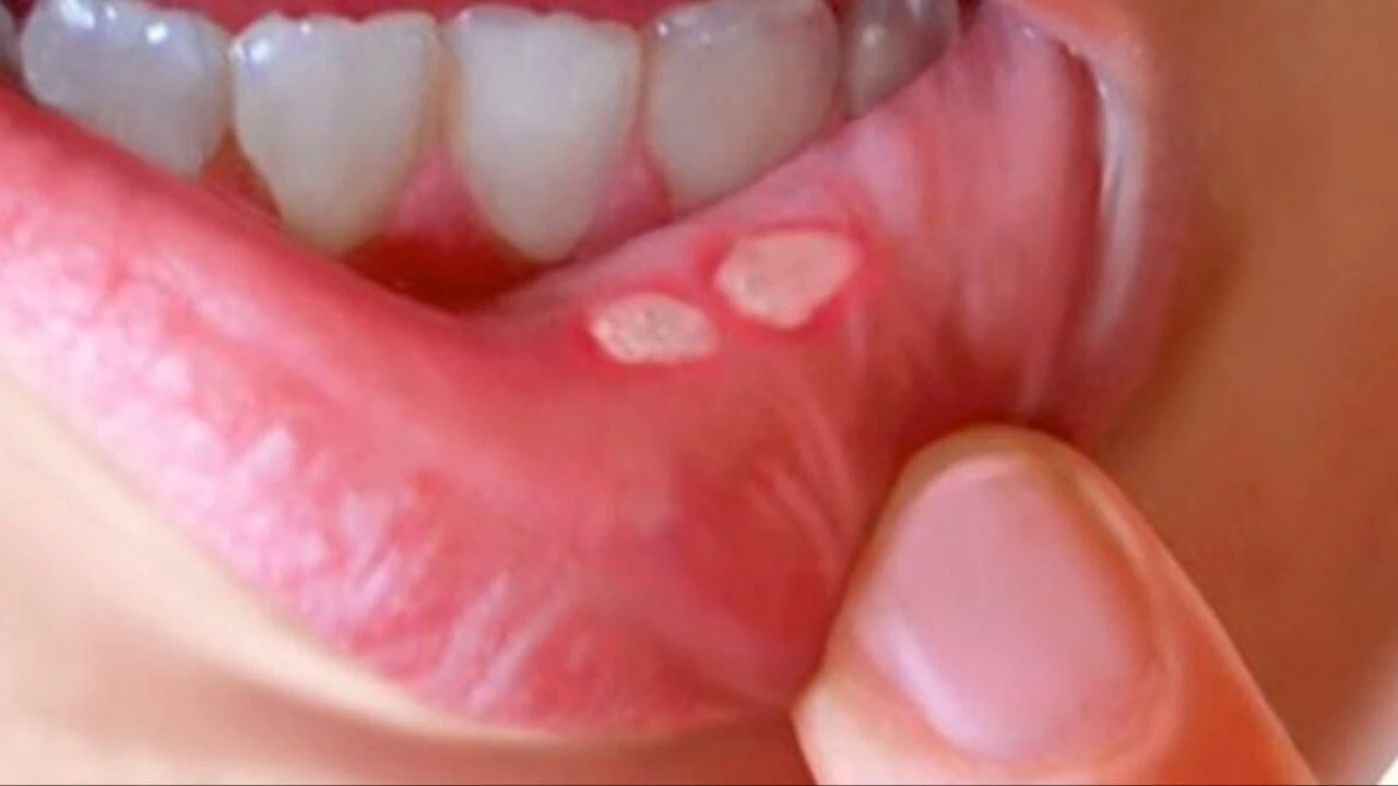 Aft için doğal tedavi yolları nedir? Bitkisel yöntemlerle aft en hızlı nasıl geçer?