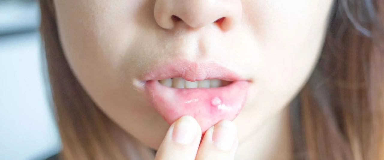 Aft için doğal tedavi yolları nedir? Bitkisel yöntemlerle aft en hızlı nasıl geçer?