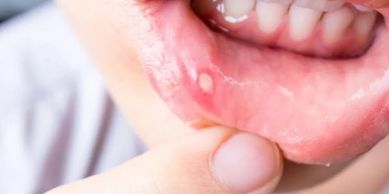 Aft için doğal tedavi yolları nedir? Bitkisel yöntemlerle aft en hızlı nasıl geçer?