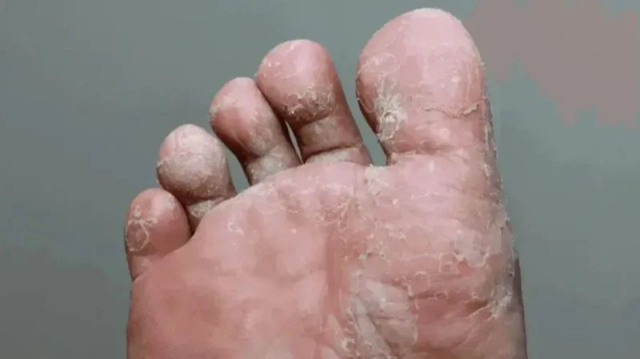 Ayak mantarı neden olur, nasıl geçer? Ayak mantarına ne iyi gelir? - 4. Resim