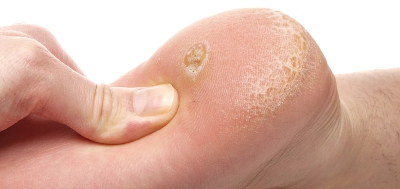 Ayak mantarı neden olur, nasıl geçer? Ayak mantarına ne iyi gelir? - 2. Resim