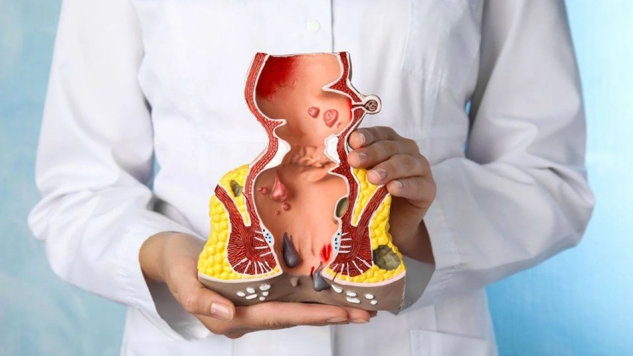 Basur neden olur ve nasıl geçer? Basura ne iyi gelir?