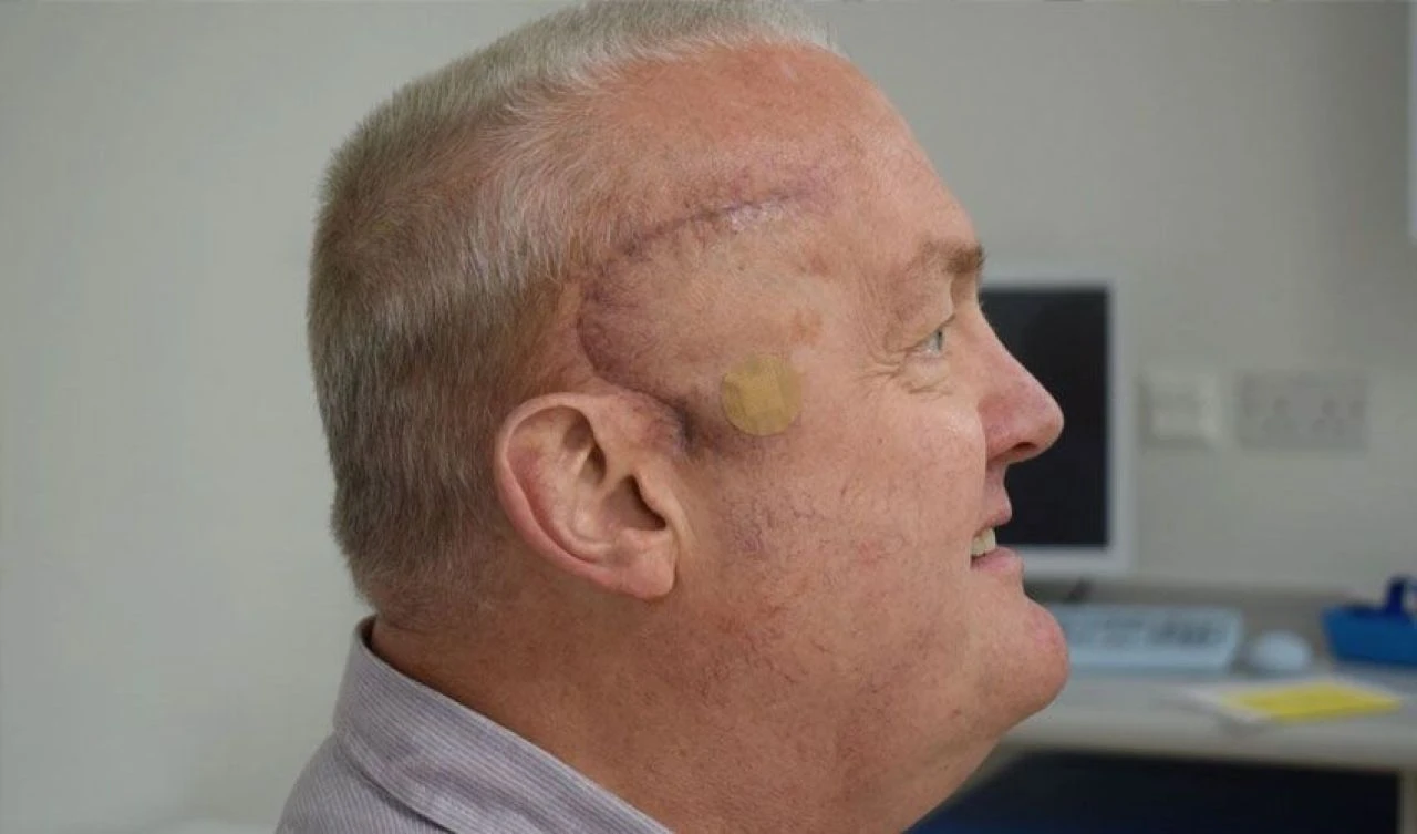 Beyin tümörü hastaları için yeni tedavi umut ışığı oldu: Yarı yarıya küçüldü - 2. Resim