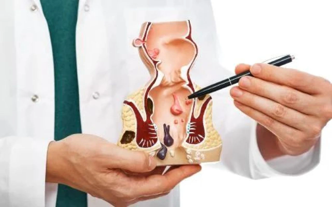 Evde basur tedavisi: Bitkisel yöntemler ile evde basur tedavisi nasıl olur? - 1. Resim