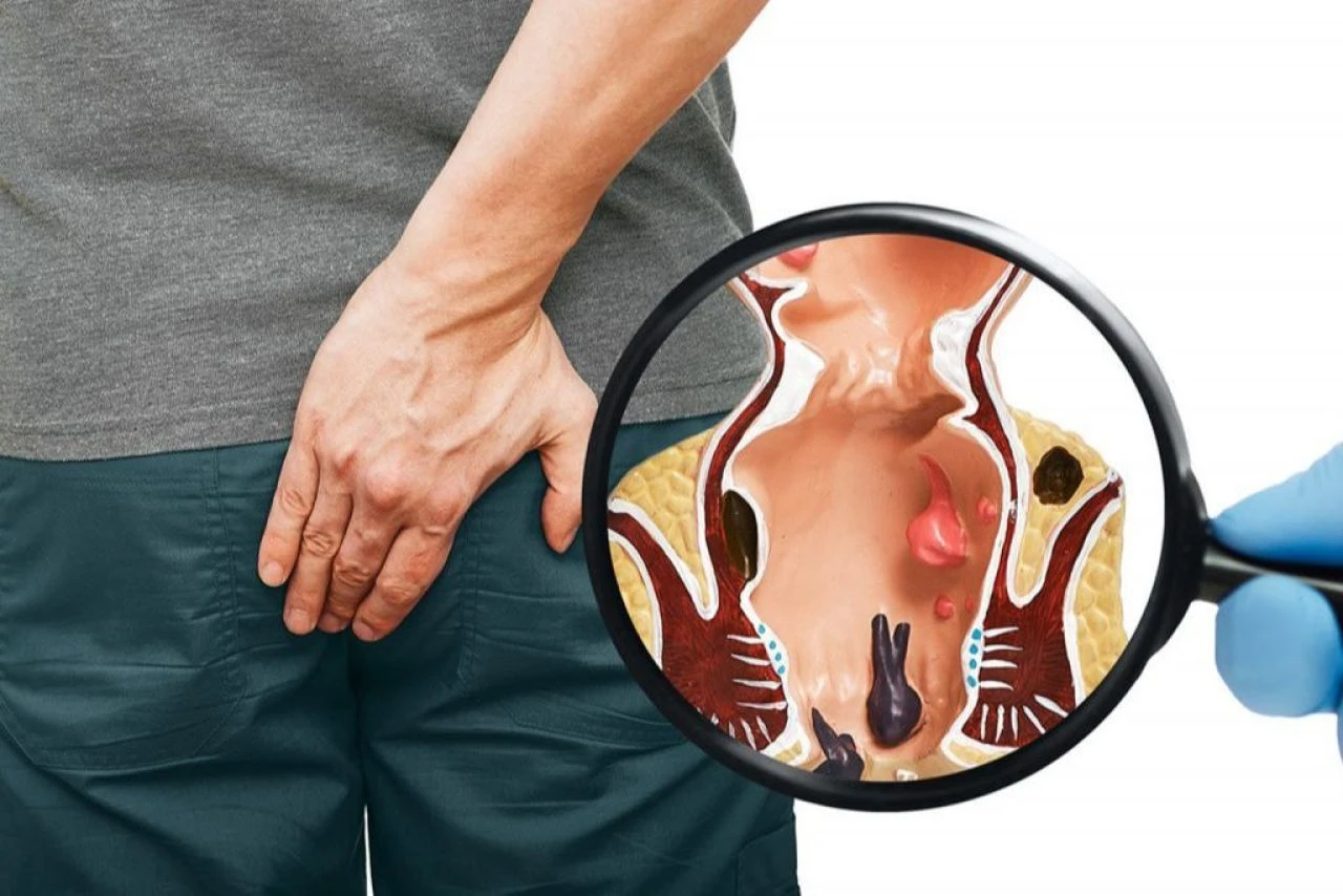 Evde basur tedavisi: Bitkisel yöntemler ile evde basur tedavisi nasıl olur? - 3. Resim