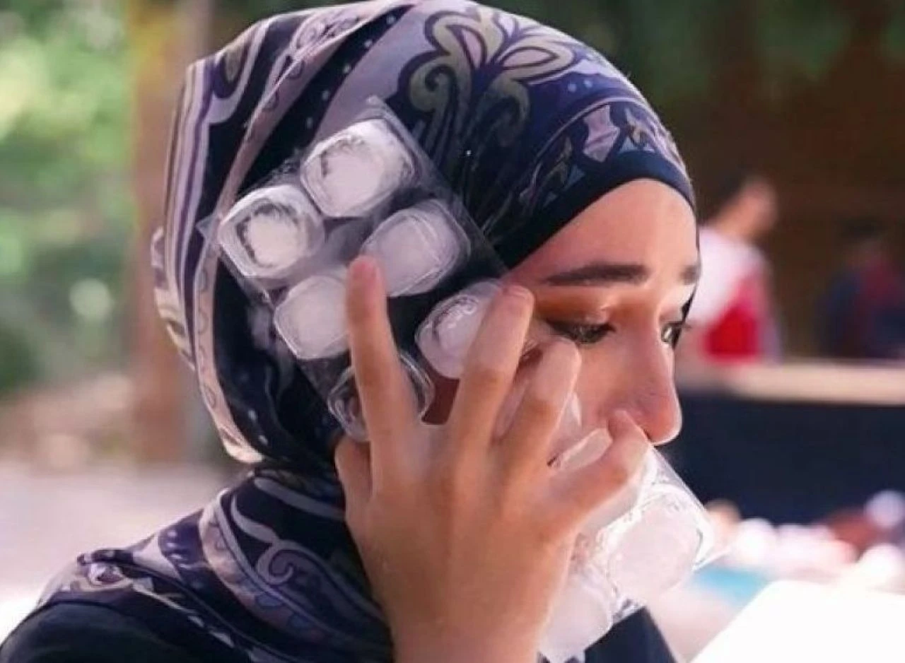 Masterchef Beyza'nın yüzü yanmıştı! Son sağlık durumu ile ilgili açıklama geldi - 1. Resim