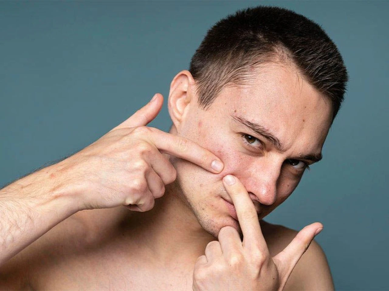 Sivilce lekeleri neden olur, nasıl geçer? Sivilce lekelerine ne iyi gelir? - 4. Resim