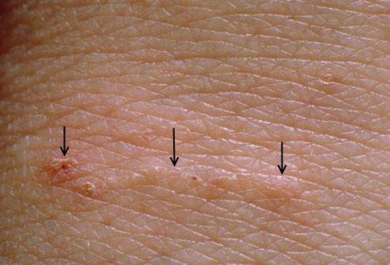 Uyuz hastalığı doğrudan cilt teması sonucu yayılıyor - 3. Resim