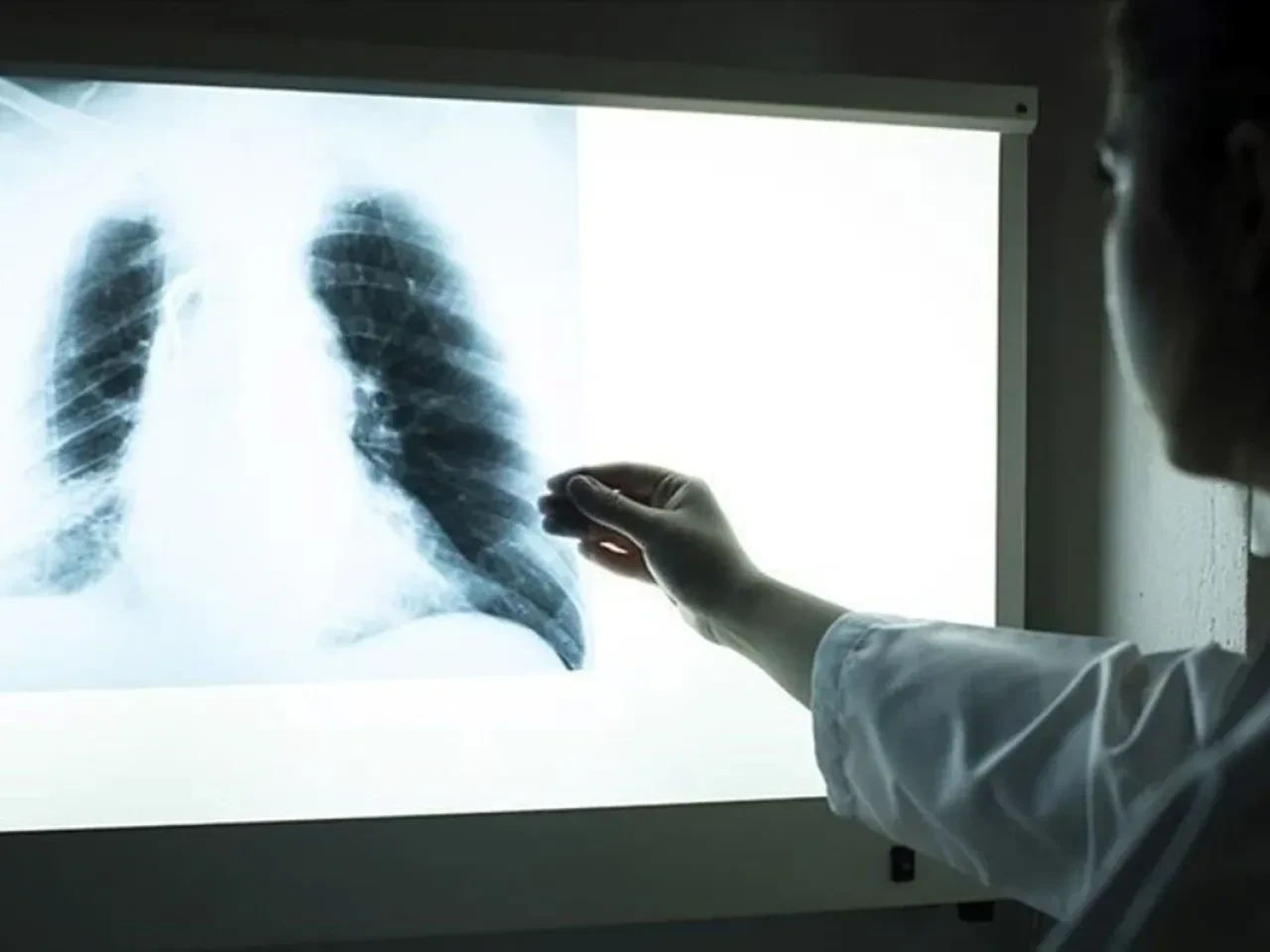 Verem bulaşıcı mı? Rekor artışla dünyanın en ölümcül hastalığı oldu