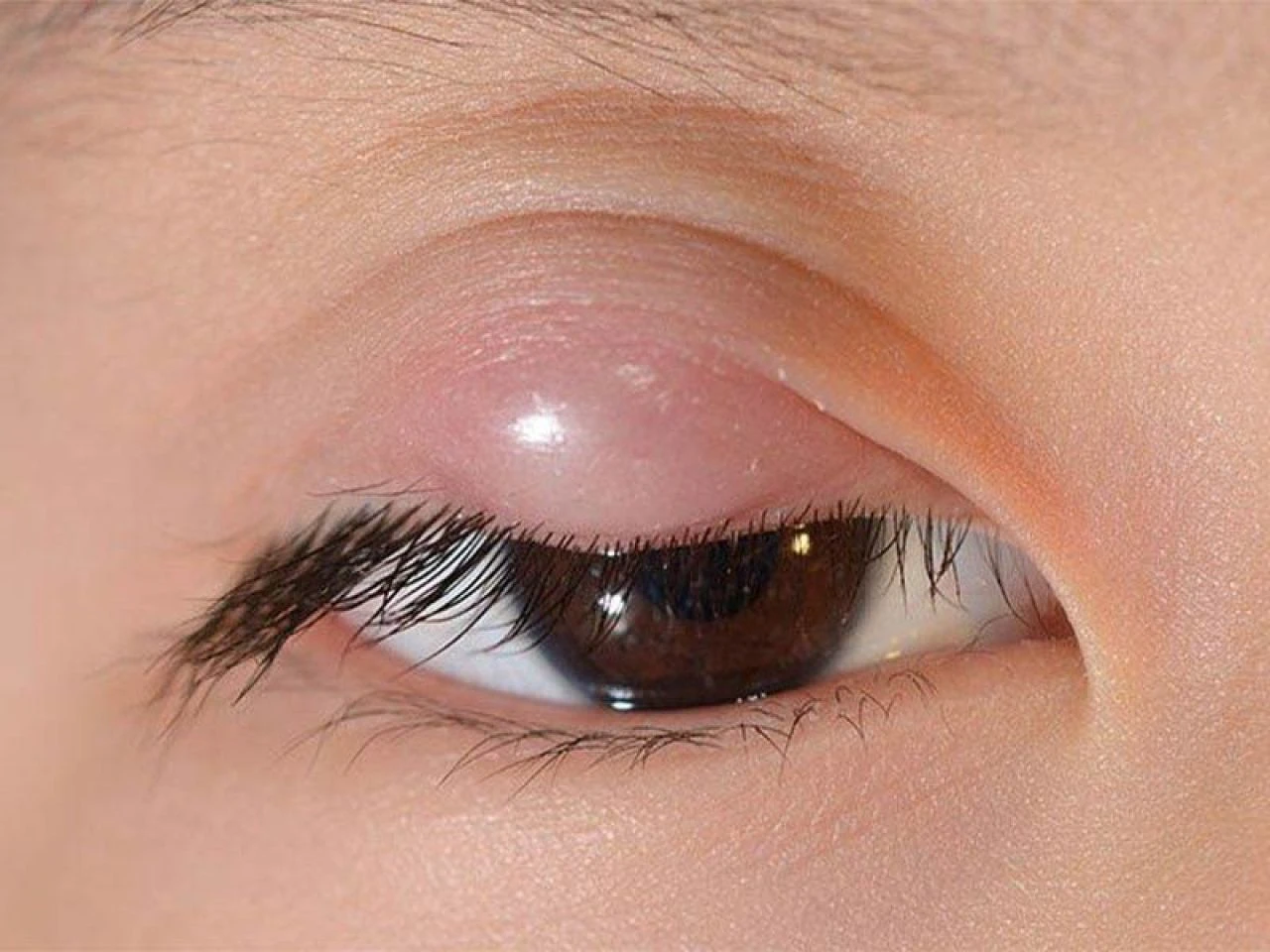 Yağ bezesine iyi gelen şeyler ve doğal çözümler: Yağ bezesine iyi gelen yağlar, bitkiler ve yiyecekler neler?