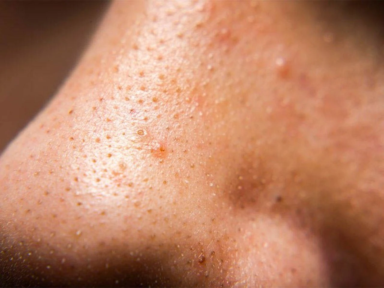 Siyah nokta neden olur, nasıl geçer? Siyah noktalara ne iyi gelir? - 1. Resim