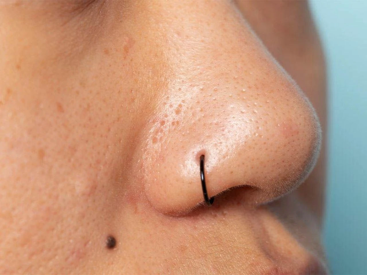 Siyah nokta neden olur, nasıl geçer? Siyah noktalara ne iyi gelir? - 3. Resim