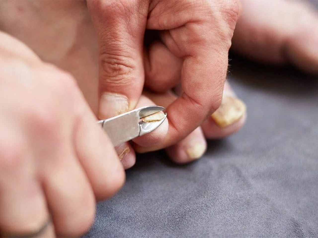 Tırnak batması neden olur ve nasıl geçer? Çok ağrıtan tırnak batmasına ne iyi gelir? - 4. Resim