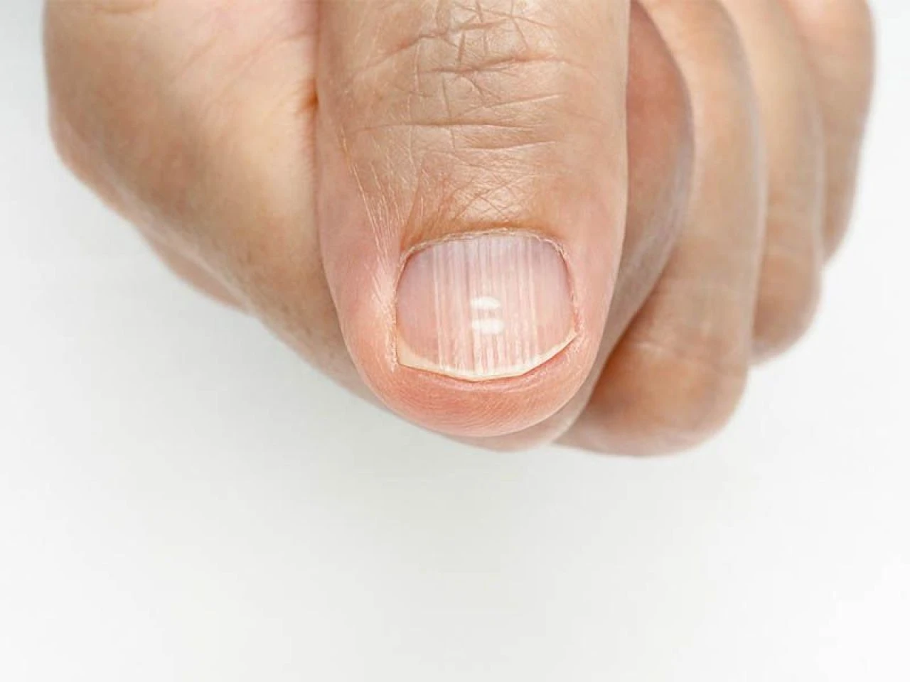 Tırnak batması neden olur ve nasıl geçer? Çok ağrıtan tırnak batmasına ne iyi gelir? - 1. Resim