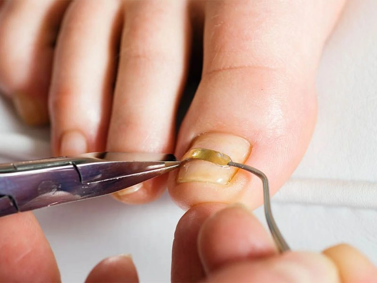 Tırnak batması neden olur ve nasıl geçer? Çok ağrıtan tırnak batmasına ne iyi gelir? - 2. Resim