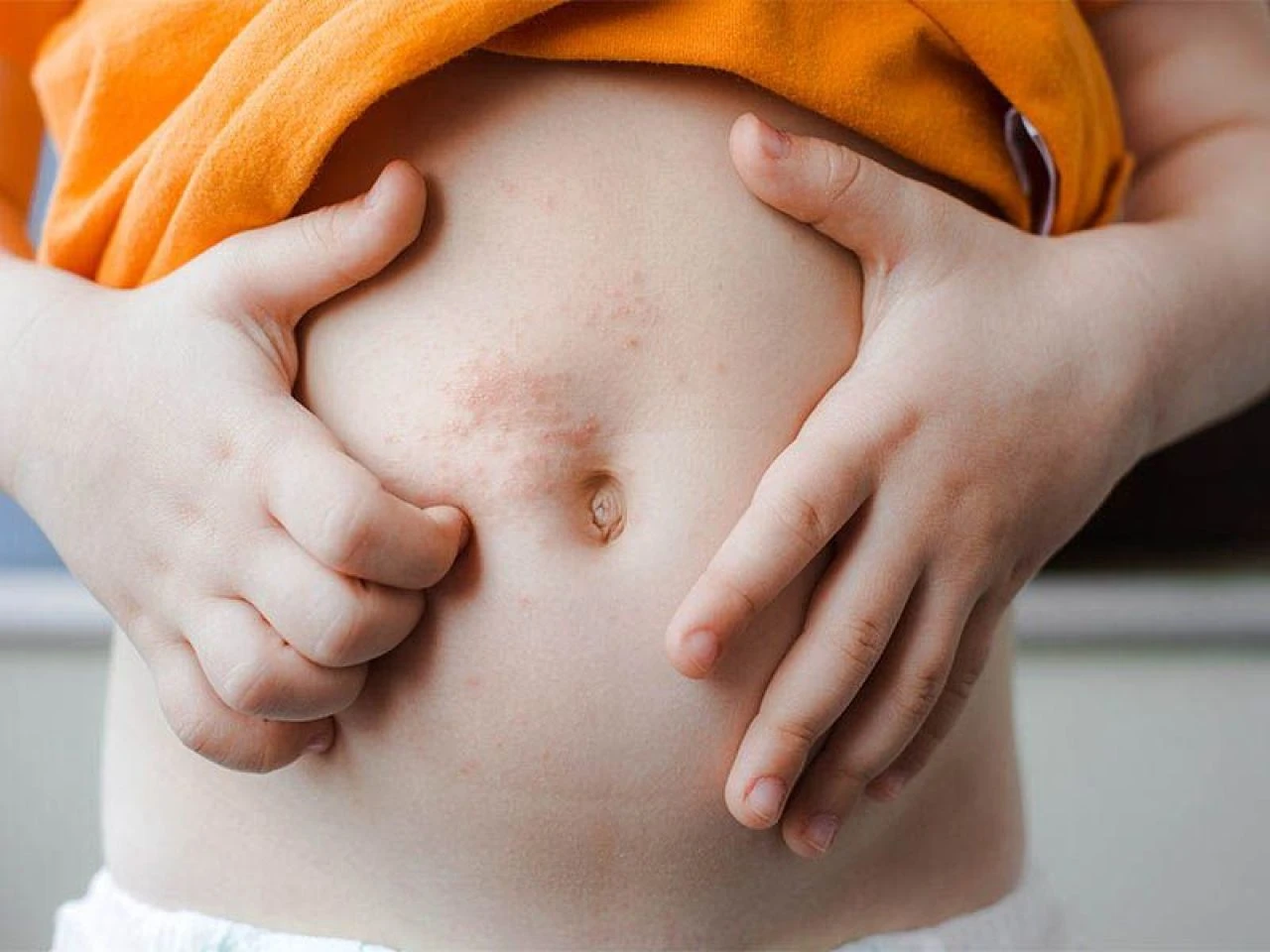 Uyuz hastalığı neden olur, nasıl geçer? Uyuz hastalığına ne iyi gelir?