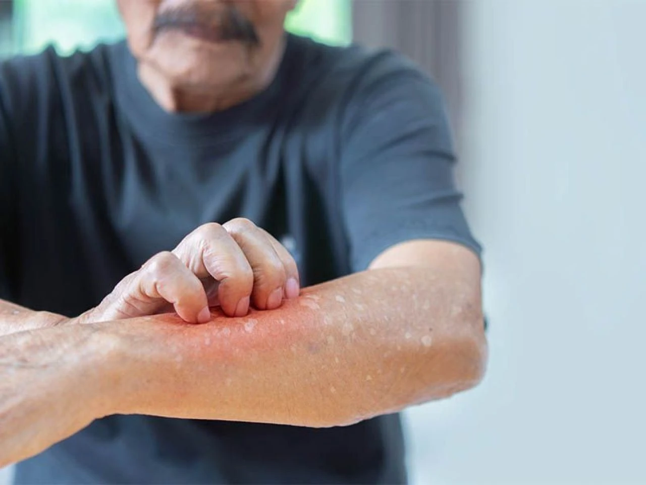 Uyuz hastalığı neden olur, nasıl geçer? Uyuz hastalığına ne iyi gelir?