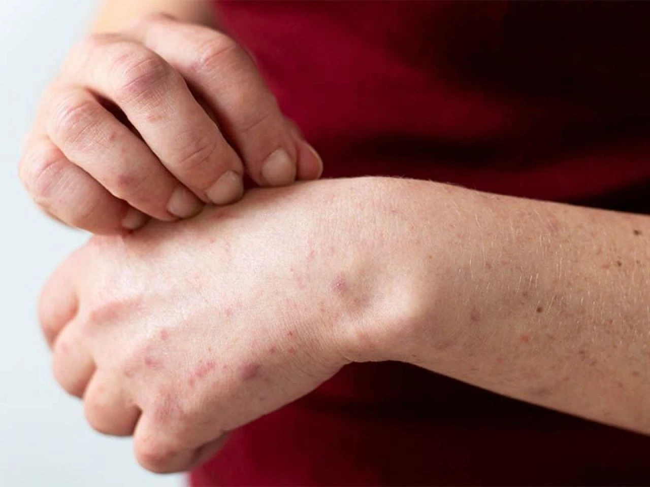 Uyuz hastalığı neden olur, nasıl geçer? Uyuz hastalığına ne iyi gelir?