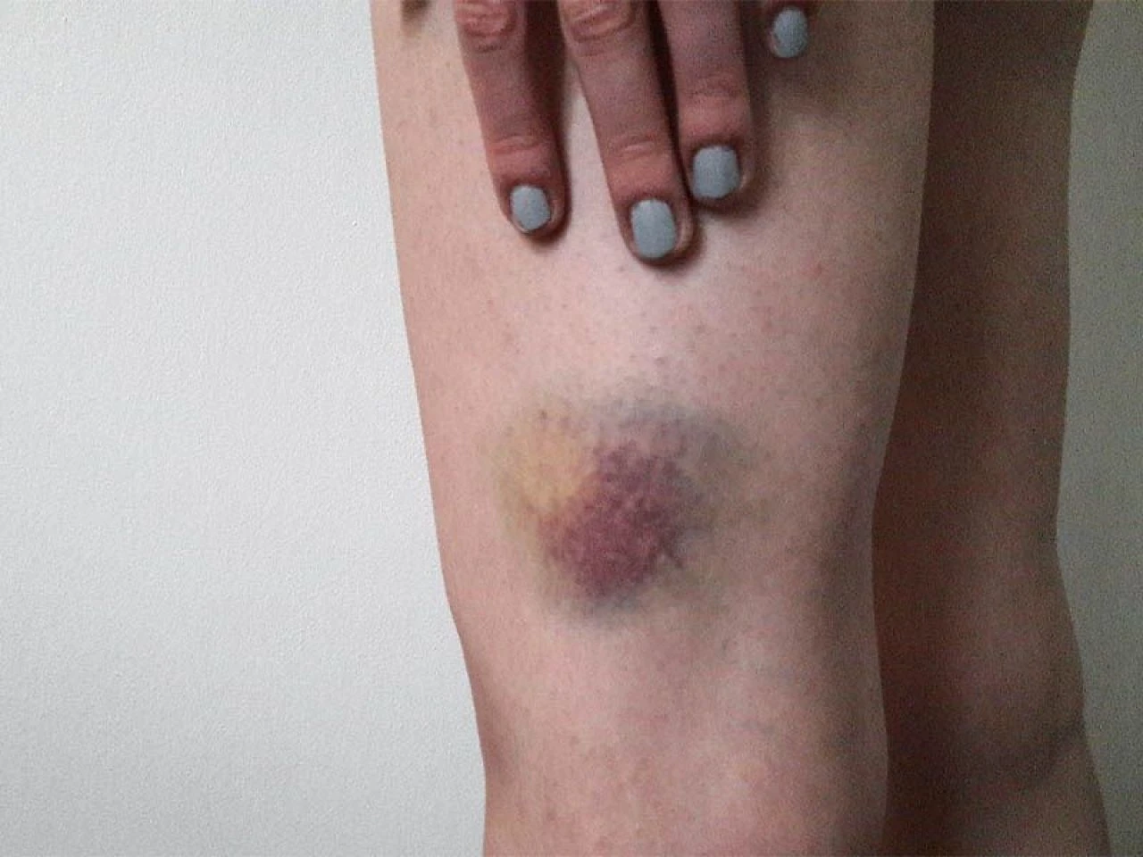 Morluklara doğal çözüm önerileri: Vücutta oluşan morluklara iyi gelen şeyler, yağlar ve bitkiler neler? - 4. Resim