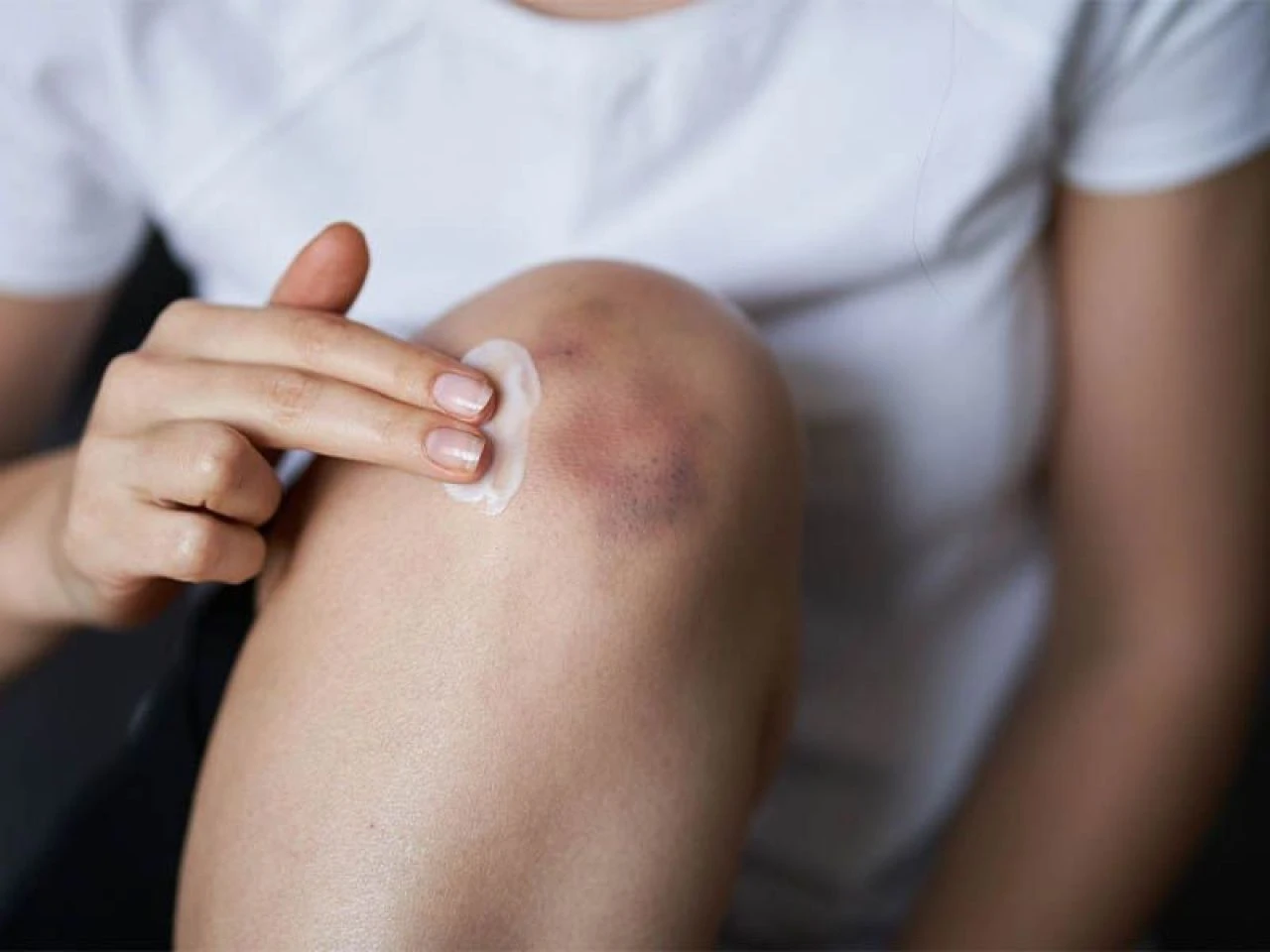 Morluklara doğal çözüm önerileri: Vücutta oluşan morluklara iyi gelen şeyler, yağlar ve bitkiler neler? - 3. Resim