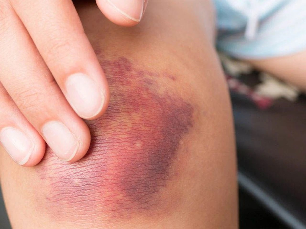 Morluklara doğal çözüm önerileri: Vücutta oluşan morluklara iyi gelen şeyler, yağlar ve bitkiler neler? - 2. Resim