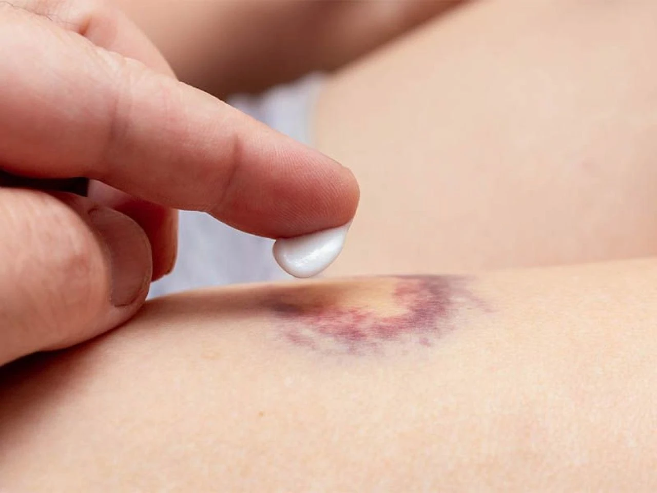 Morluklara doğal çözüm önerileri: Vücutta oluşan morluklara iyi gelen şeyler, yağlar ve bitkiler neler? - 1. Resim