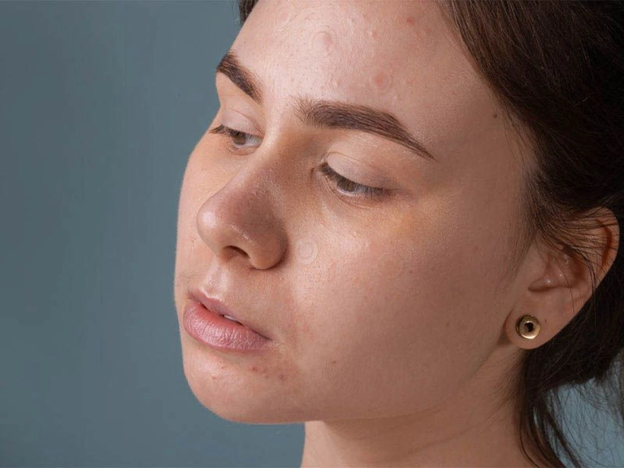 Yüzdeki lekeler neden olur, nasıl geçer? Yüzdeki lekeye ne iyi gelir?