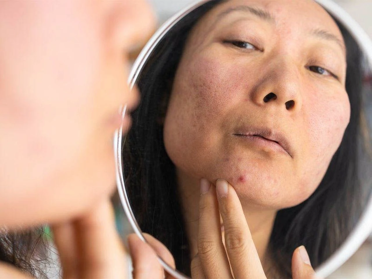 Yüzdeki lekeler neden olur, nasıl geçer? Yüzdeki lekeye ne iyi gelir?