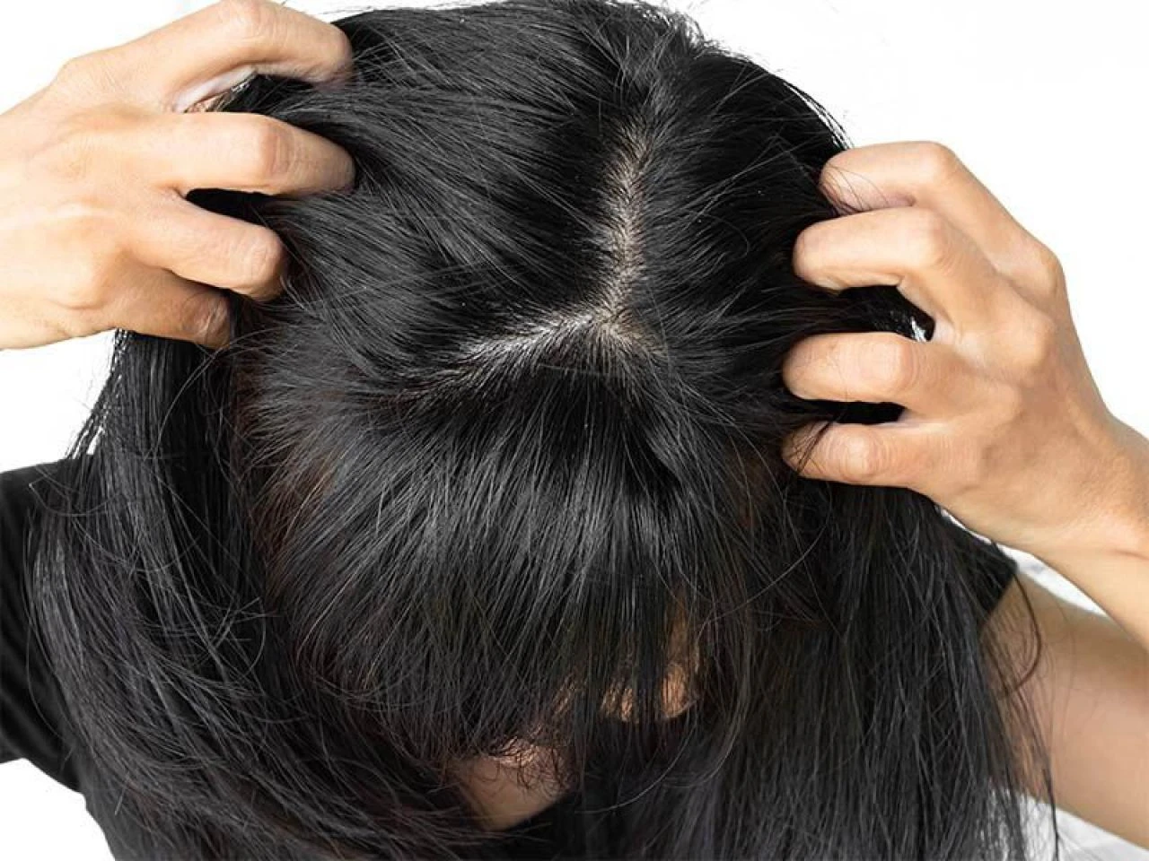 Saçtaki kepek neden olur ve en hızlı nasıl geçer? Saç kepeğine ne iyi gelir? - 2. Resim