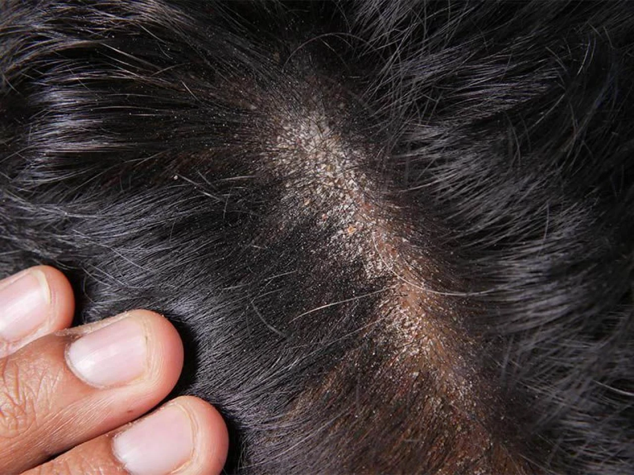 Saçtaki kepek neden olur ve en hızlı nasıl geçer? Saç kepeğine ne iyi gelir? - 1. Resim