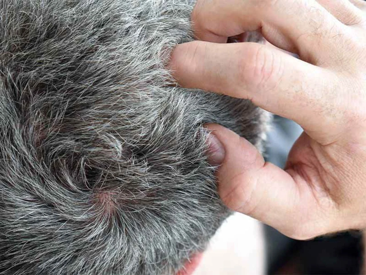 Saçtaki kepek neden olur ve en hızlı nasıl geçer? Saç kepeğine ne iyi gelir? - 4. Resim