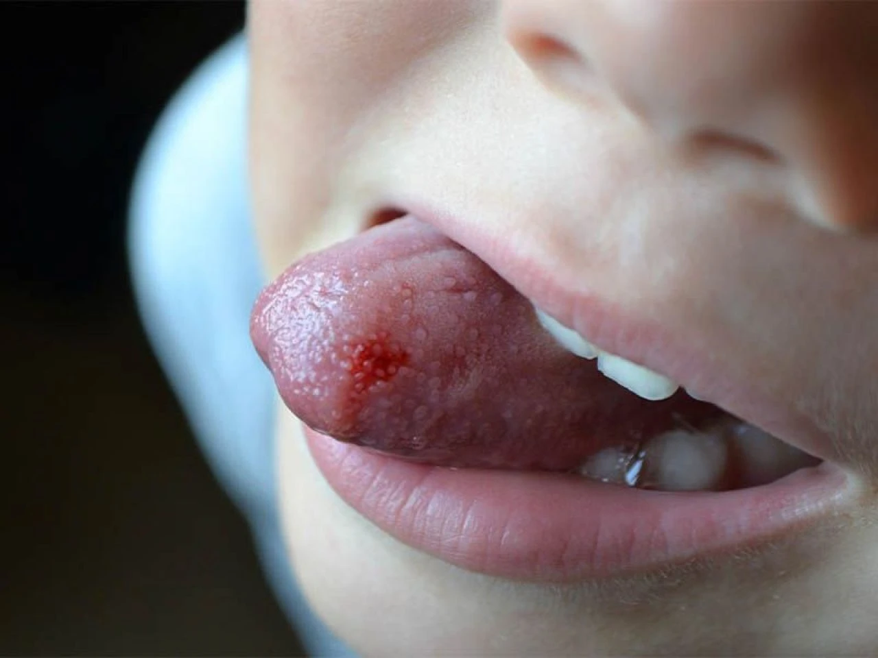 Dil yarası neden olur, en hızlı nasıl geçer? Dildeki yaraya ne iyi gelir? - 2. Resim