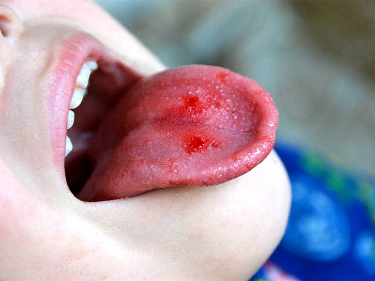Dil yarası neden olur, en hızlı nasıl geçer? Dildeki yaraya ne iyi gelir? - 4. Resim