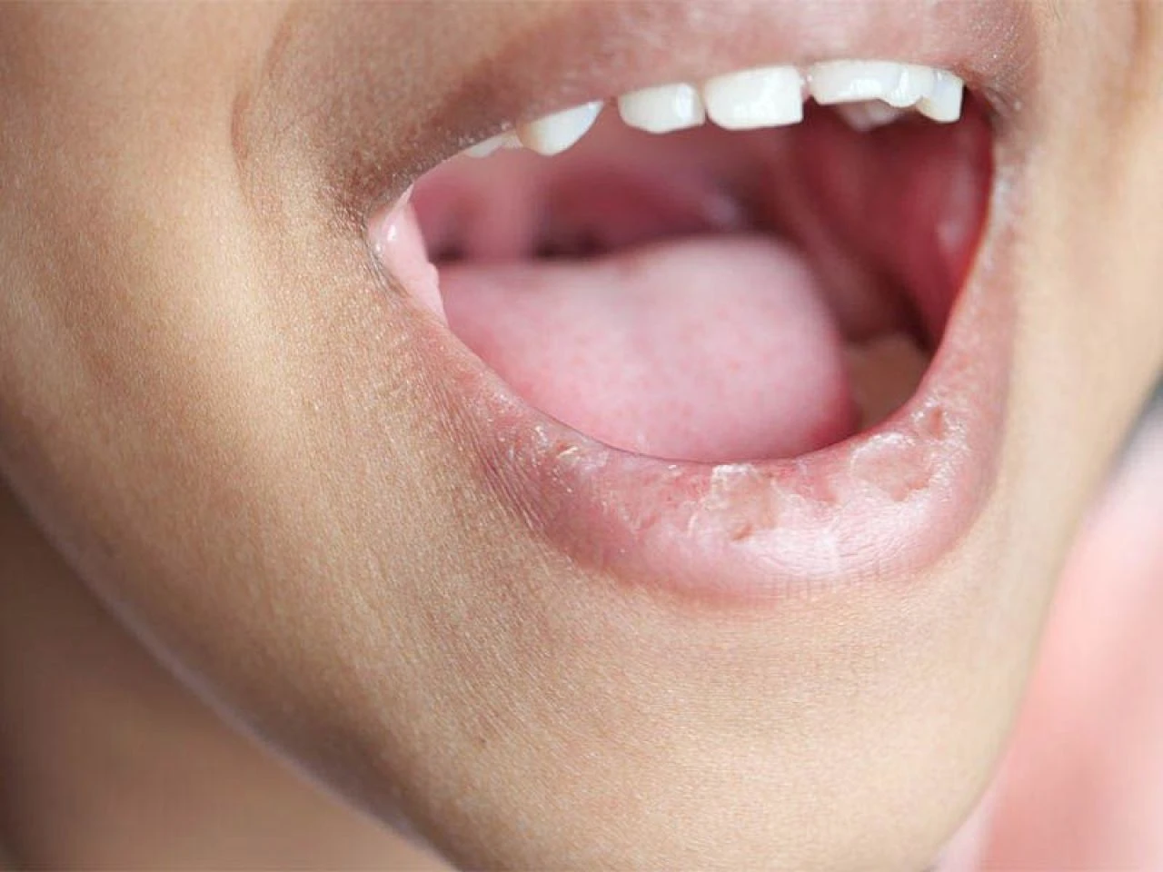 Dil yarası neden olur, en hızlı nasıl geçer? Dildeki yaraya ne iyi gelir? - 3. Resim