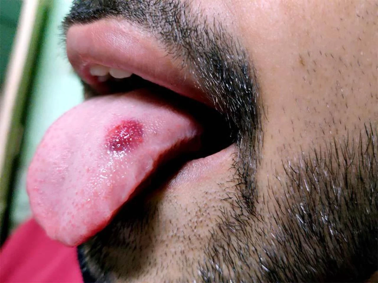 Dil yarası neden olur, en hızlı nasıl geçer? Dildeki yaraya ne iyi gelir? - 1. Resim