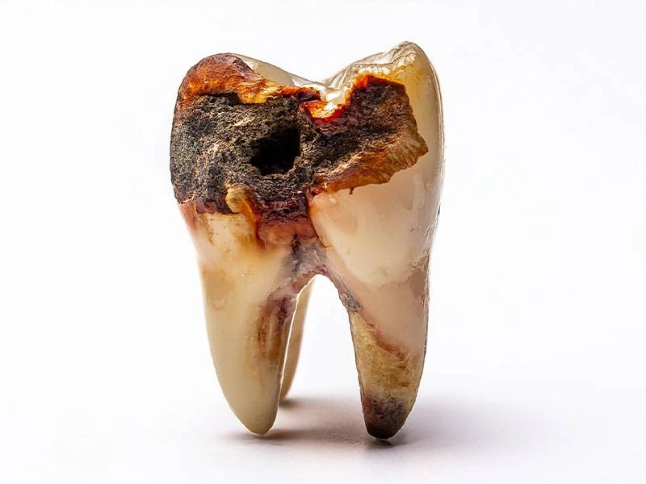 Diş çürüğü neden olur, en hızlı nasıl geçer? Diş çürüğü ağrısına ne iyi gelir? - 2. Resim