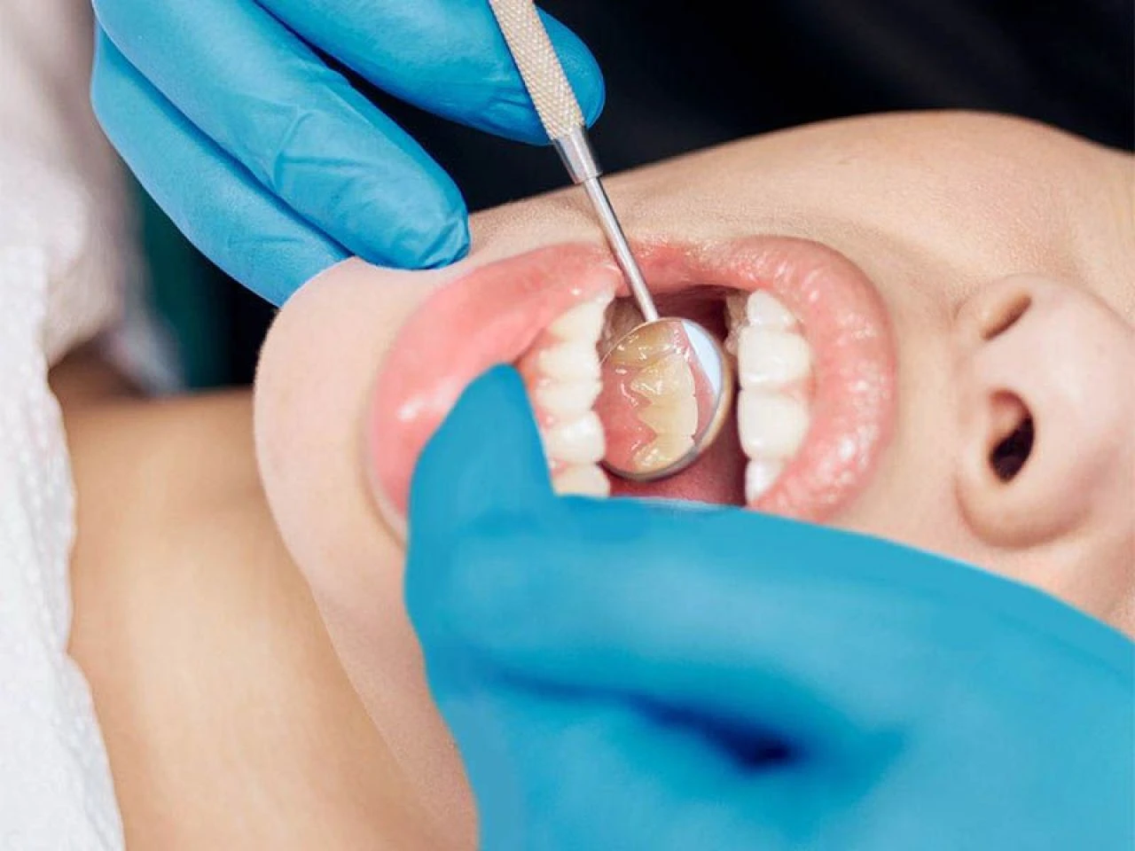 Diş çürüğü neden olur, en hızlı nasıl geçer? Diş çürüğü ağrısına ne iyi gelir? - 3. Resim