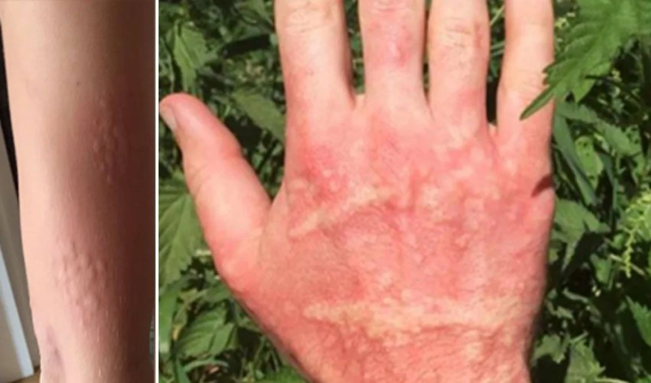 Dokunanı yakan istilacı bitki ülkenin sorunu haline geldi! Uzmanlardan uyarı geldi