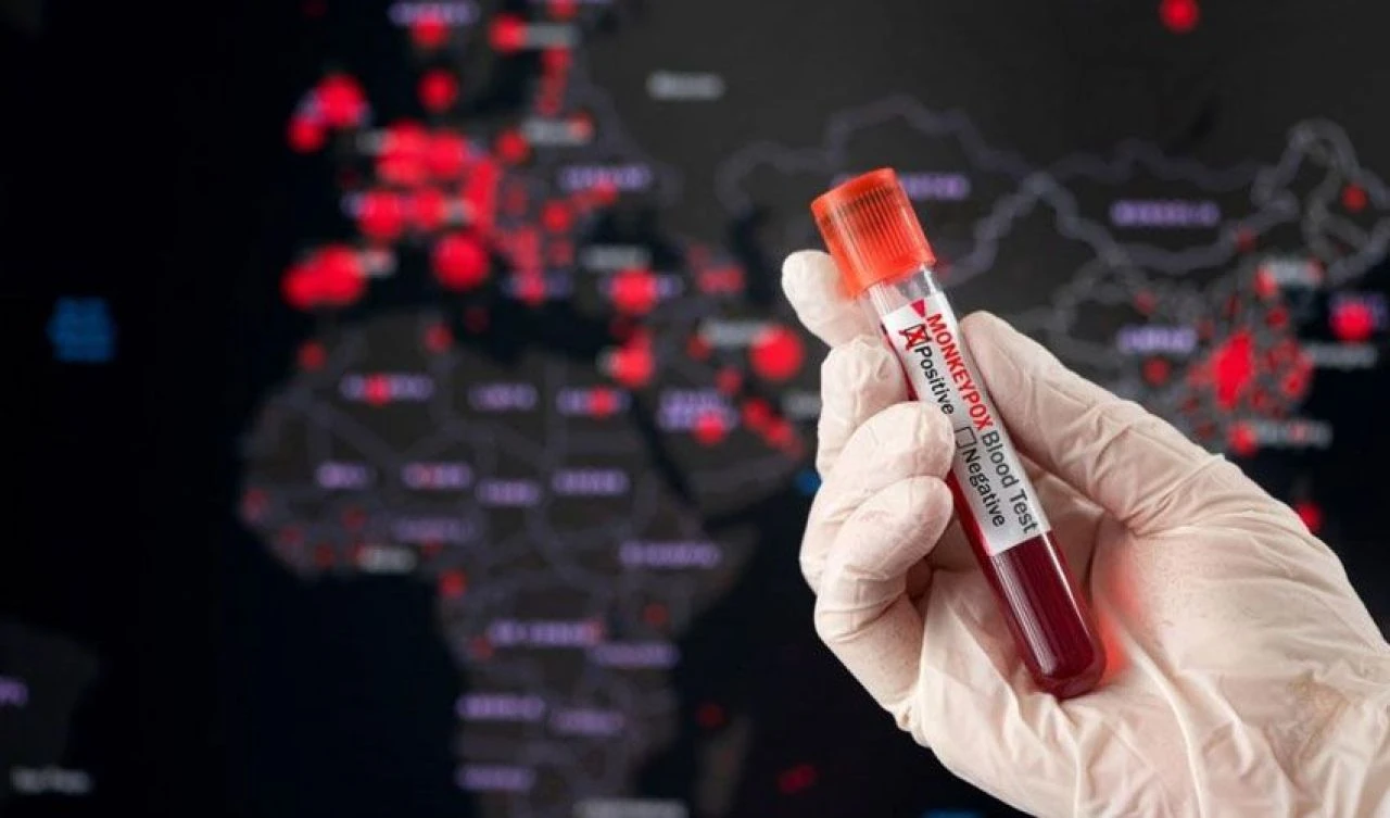 Maymun Çiçeği, Avrupa'yı alarma geçirdi! Kosova'da ilk vaka tespit edildi