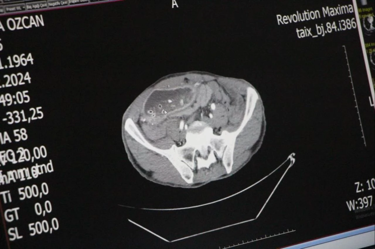 65 yaşındaki adamı gören doktorlar şaştı kaldı! "Hamile gibi..." - 1. Resim