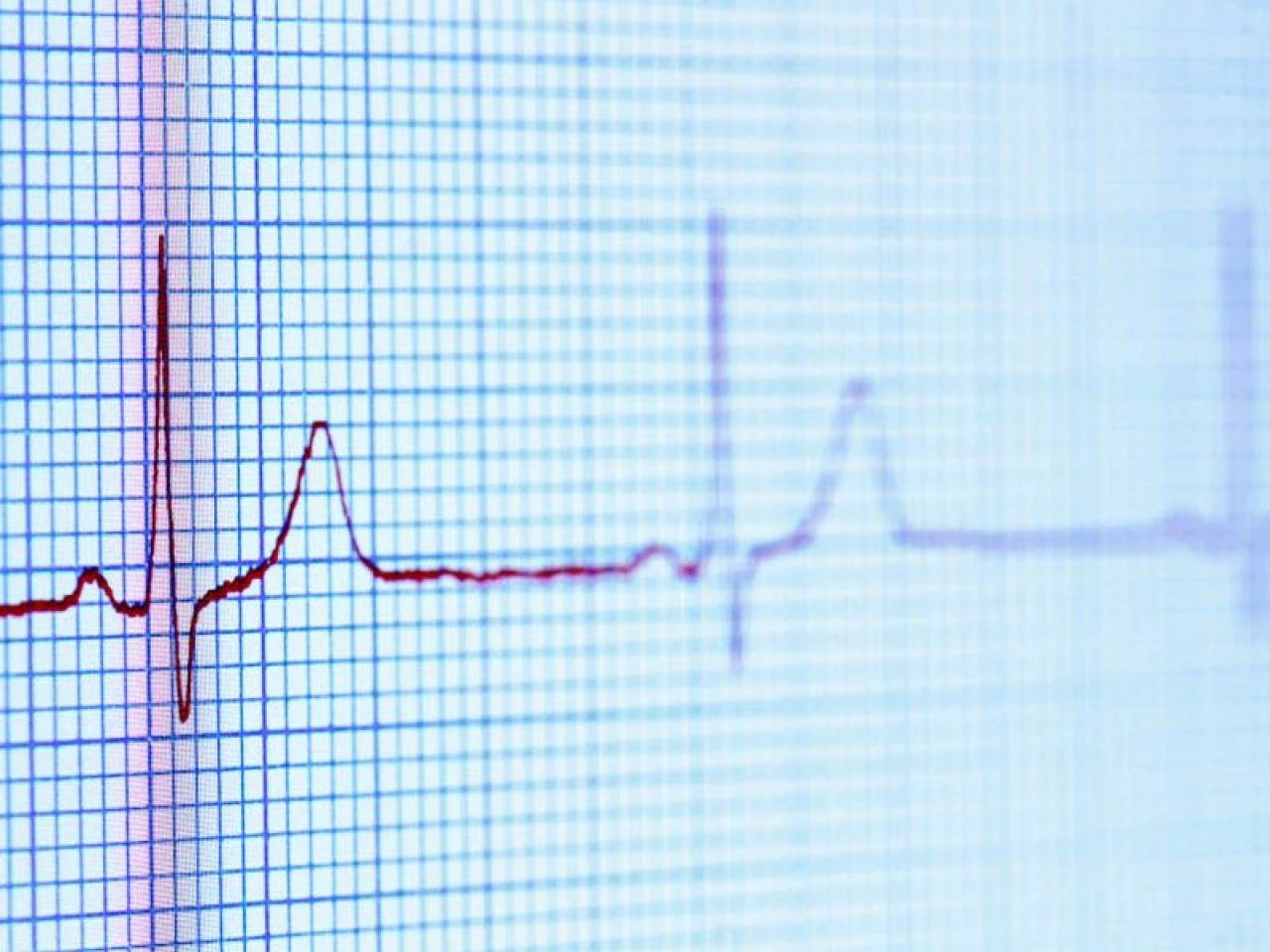 Kalp çarpıntısı için doğal çözüm önerileri: Evde kalp çarpıntısına iyi gelen şeyler, çaylar ve besinler neler?