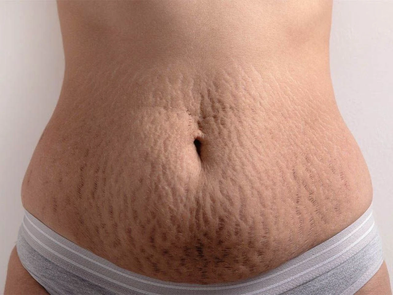 Vücut çatlaklarına iyi gelen doğal çözümler ve yağlar neler? Evde vücut çatlaklarına ne iyi gelir? - 4. Resim