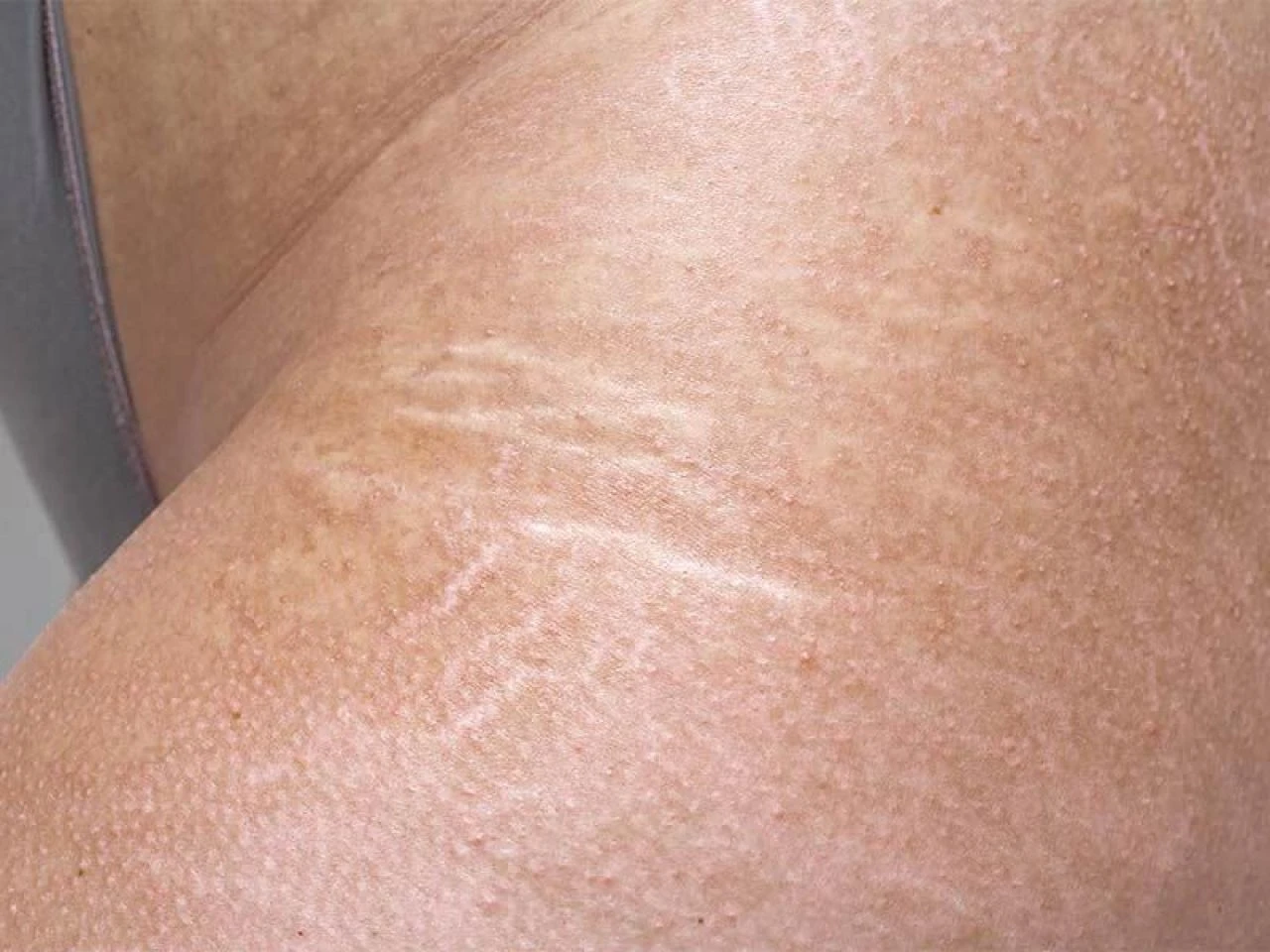 Vücut çatlaklarına iyi gelen doğal çözümler ve yağlar neler? Evde vücut çatlaklarına ne iyi gelir? - 3. Resim