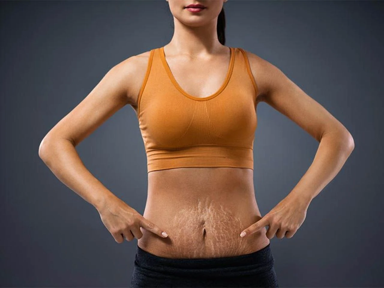 Vücut çatlaklarına iyi gelen doğal çözümler ve yağlar neler? Evde vücut çatlaklarına ne iyi gelir? - 1. Resim