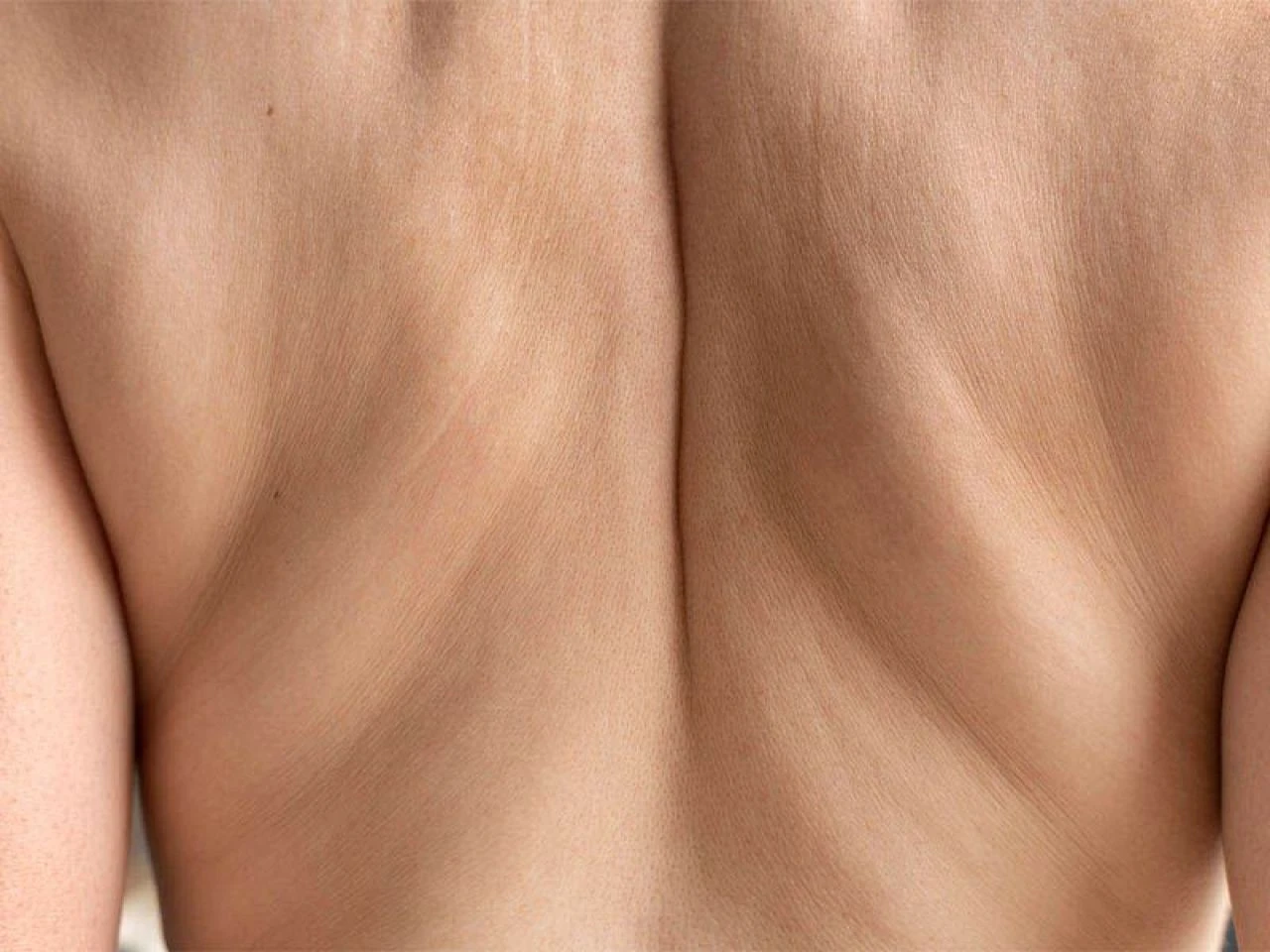 Vücutta çatlaklar neden olur, en hızlı nasıl geçer? Çatlaklara ne iyi gelir? - 3. Resim