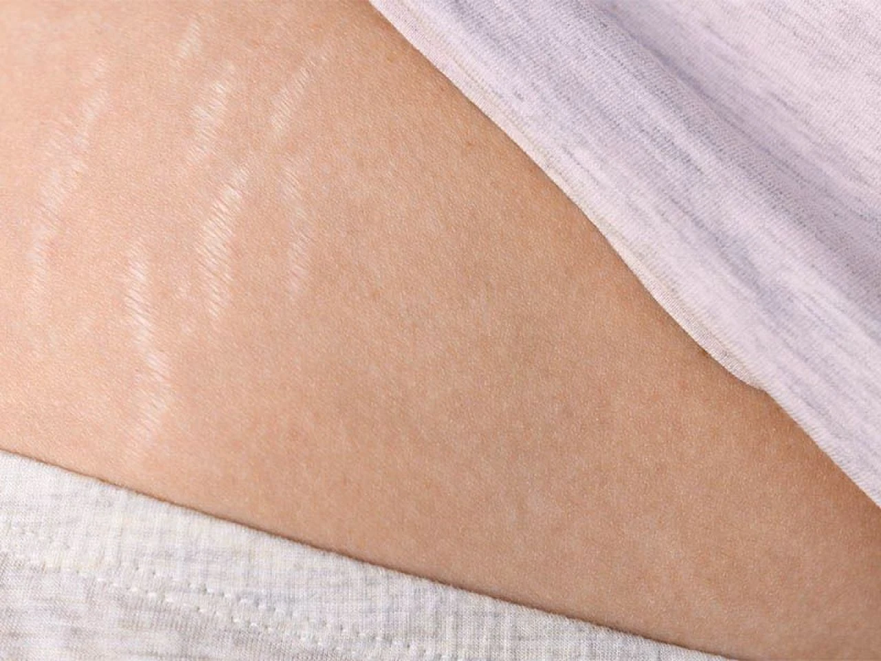 Vücutta çatlaklar neden olur, en hızlı nasıl geçer? Çatlaklara ne iyi gelir? - 4. Resim